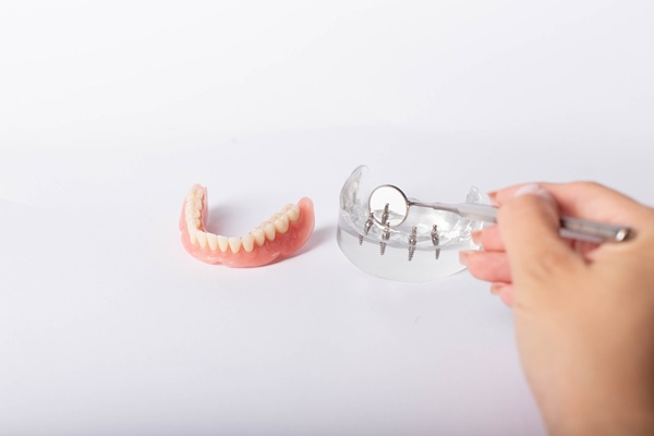 Facts You Need To Know About All On   Implants