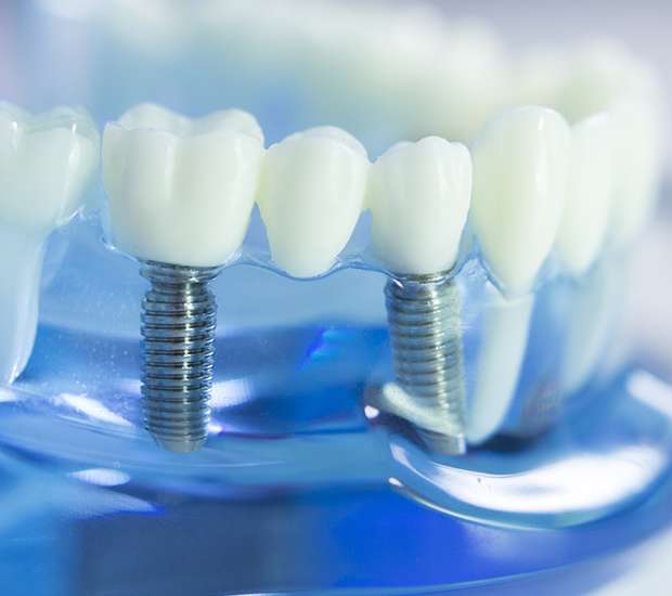 Bogota Dental Implants